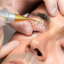 Plasma Lift - Ögonlyft