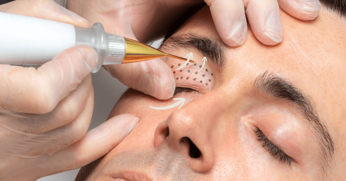 Plasma Lift - Ögonlyft