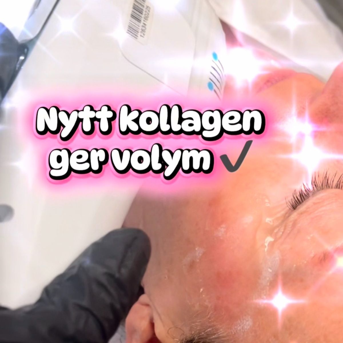 HIFU 2026, varför fler väljer ansiktslyft utan kirurgi